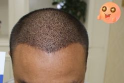 -大麦微针植发丨全国连锁