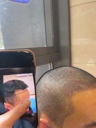 -碧莲盛·不剃发植发