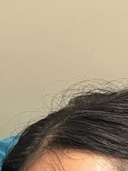 -碧莲盛·不剃发植发