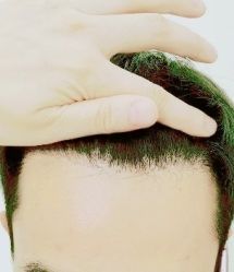 -大麦微针植发丨全国连锁