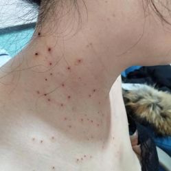 -北京美痣堂古方祛痣斑疣瘊