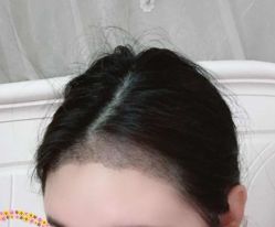 -大麦微针植发丨全国连锁