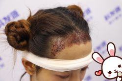 点击看大图 -大麦微针植发丨全国连锁