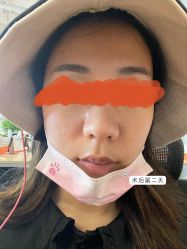 体验后-依萱绮医疗美容