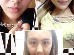 开好之后素颜的样子-上海华安整形外科门诊部