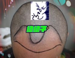 -大麦微针植发全国连锁