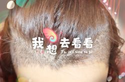 -大麦微针植发全国连锁