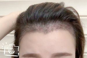 -大麦微针植发丨全国连锁