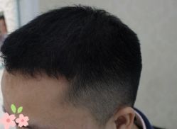 -大麦微针植发丨全国连锁