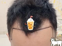 -大麦微针植发全国连锁