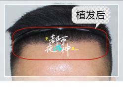 -大麦微针植发全国连锁