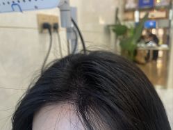 -碧莲盛·不剃发植发