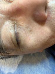 -美丽人生祛斑扁平疣汗管瘤中心