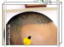 -大麦微针植发全国连锁