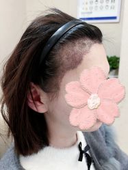 -大麦微针植发丨全国连锁