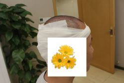 -大麦微针植发丨全国连锁