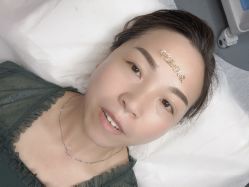 体验后-郡艺医疗美容·微整·眼鼻吸脂