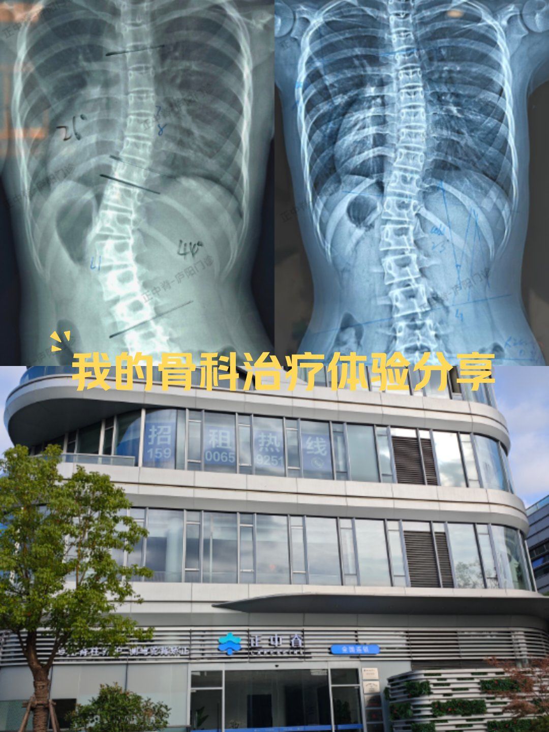 成长轨迹:骨骼x光对比