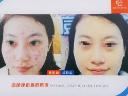 -悟空祛痘·诺奖技术专业店