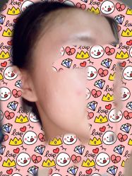 体验后-叶美人医疗美容