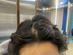 -碧莲盛不剃发植发