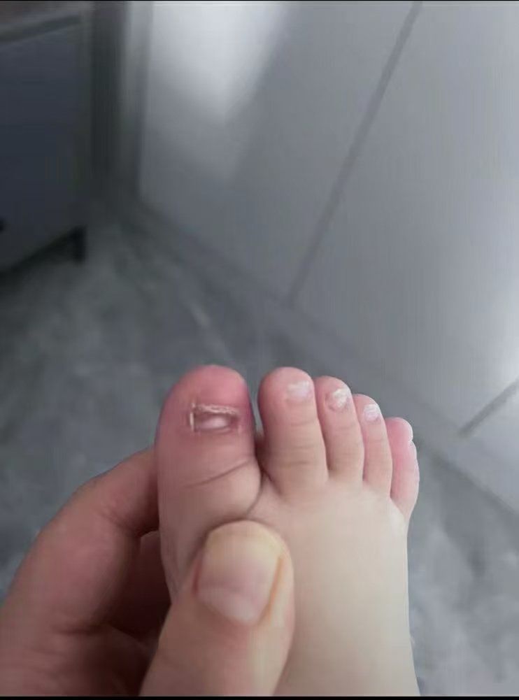小朋友的灰指甲