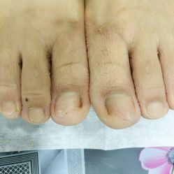 -德哥灰指甲脚气甲沟炎跖疣护理