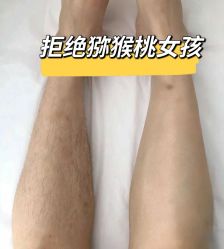 -薇兰专业脱毛连锁机构