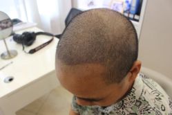 -大麦微针植发丨全国连锁