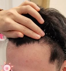 -大麦微针植发丨全国连锁