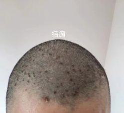 -爱莎扁平疣·汗管瘤·斑痣中心