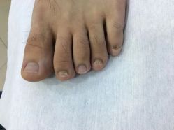 -德哥灰指甲脚气甲沟炎跖疣护理
