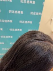 -碧莲盛·不剃发植发