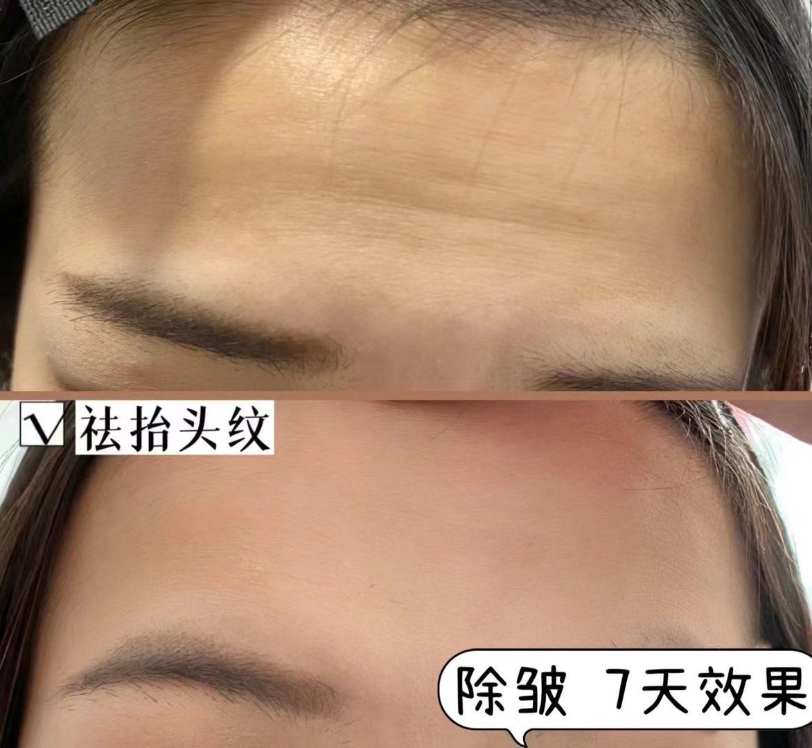 弹力纤维断裂  靠祛皱针都救不了!