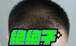 -大麦微针植发丨全国连锁