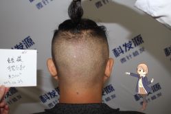 -大麦微针植发丨全国连锁