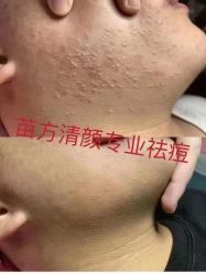 -苗方清颜专业祛痘连锁机构