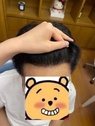 -大麦微针植发全国连锁