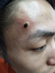 -北京美痣堂古方祛痣斑疣瘊