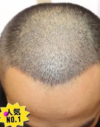 -大麦微针植发丨全国连锁