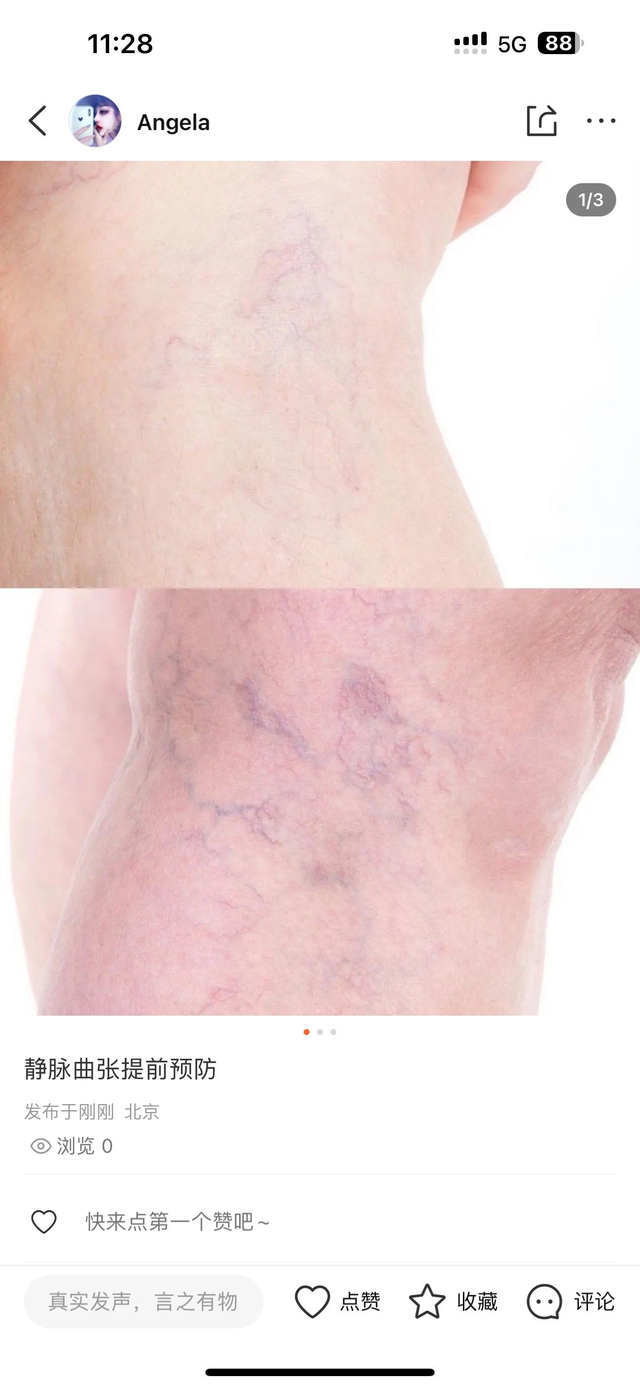 看看这些静脉曲张照片,腿部循环代谢慢,容易造