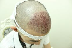 点击看大图 -大麦微针植发丨全国连锁