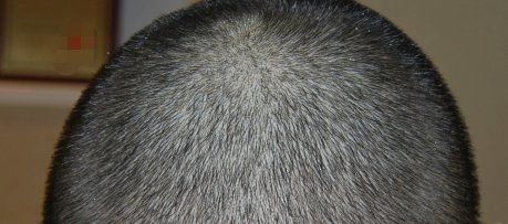 -大麦微针植发丨全国连锁