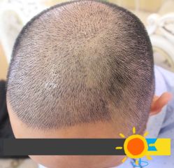 -大麦微针植发丨全国连锁