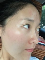 体验后-东剑医学美容·注射美学中心