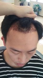 -大麦微针植发丨全国连锁