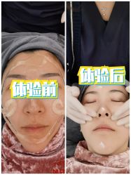 体验后-More摩尔医美の注射线雕光电中心