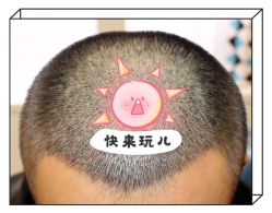 -大麦微针植发全国连锁