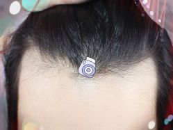 -大麦微针植发全国连锁