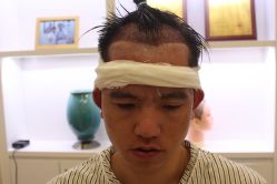 -大麦微针植发丨全国连锁